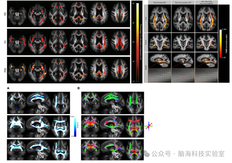 基于Fixel分析太难？脑海科技多模态脑影像云平台一键解锁白质纤维束全分析流程！