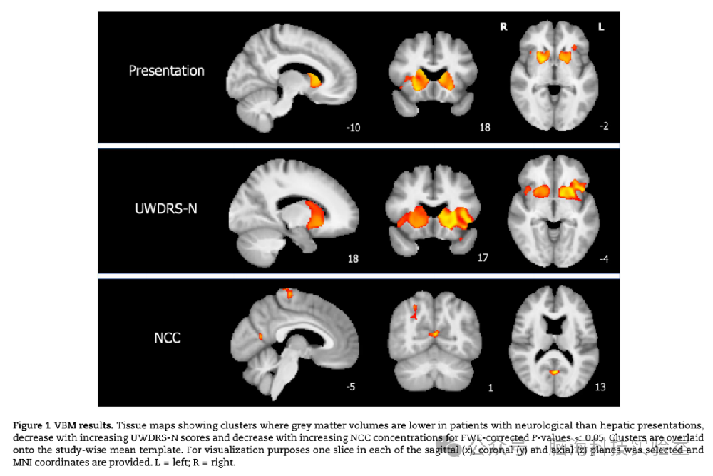 Brain：威尔逊病脑损伤的神经影像学相关因素：一项多模态全脑磁共振成像研究
