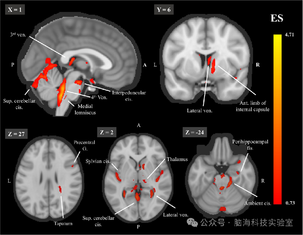 Hum Brain Mapp.：从深度学习模型回归大脑：揭示区域预测因子及其与衰老的关系