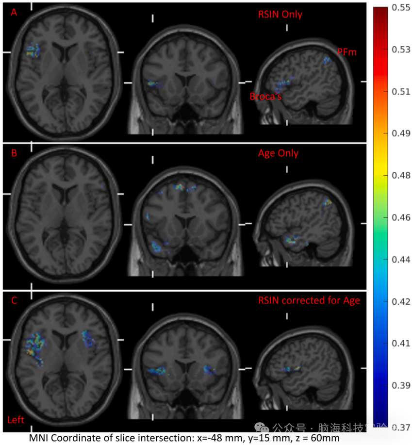 BRAIN LANG：新发现！大脑网络重新调整以补偿在嘈杂环境中的听力困难