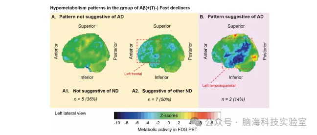 Molecular Psychiatry：特定蛋白对阿尔茨海默病记忆衰退进程存在影响