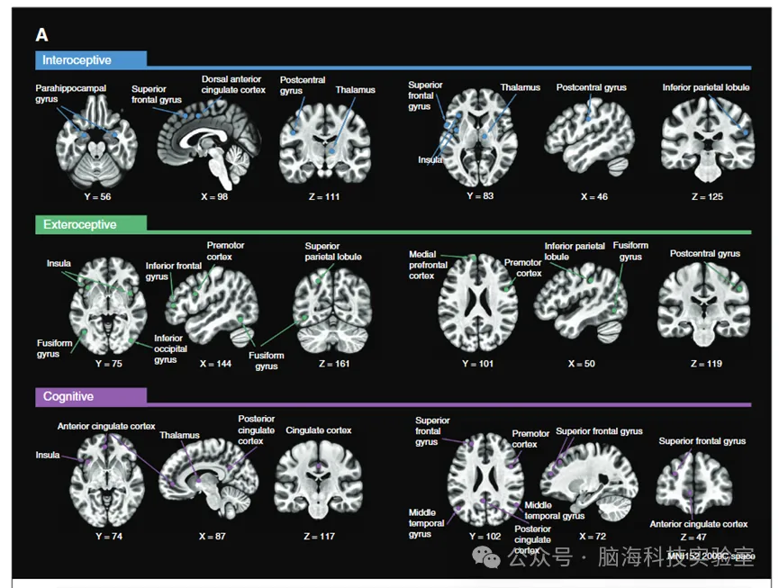 J Psychiatr Neurosci：精神分裂症患者自我加工中的内在神经时间尺度缩短且灵活性缺失
