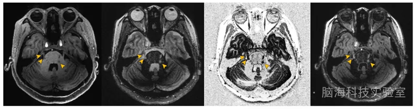 J Neurol Neurosur Ps：通过7T 磁共振技术显示的多发性硬化症的中心静脉征和三叉神经病变