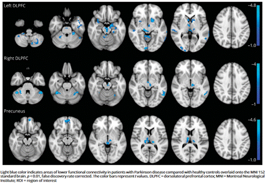 Neurology：新诊断帕金森病患者早期fMRI连接改变与不同认知表型的相关性