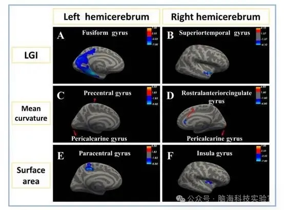 J Affect Disorders：青少年边缘型人格障碍患者大脑表面形态学及核心特征的改变