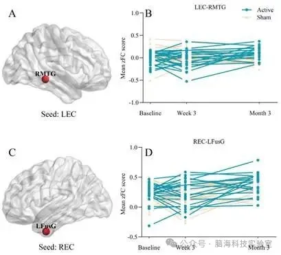 Radiology：经颅交流电刺激调节轻度阿尔茨海默病皮层与海马功能连接