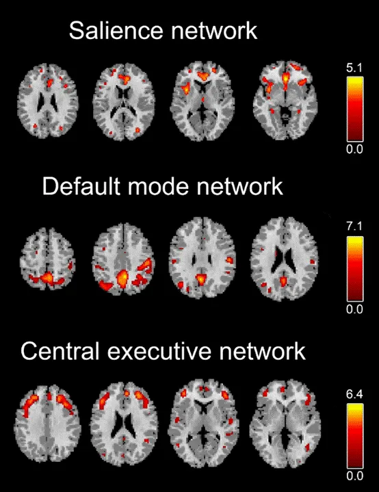 J Affect Disorders：电休克治疗后通过结构网络成像分析重度抑郁症患者与健康对照者的三重网络连接变化