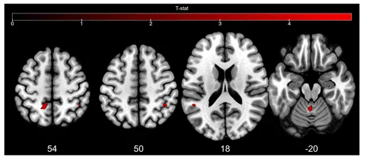NeuroImage：迟发性抑郁症中抑制控制的神经血管耦合：一项同步EEG-fMRI研究