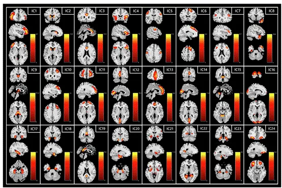 Prog Neuro-psychoph：精神分裂症阴性症状的进行性结构改变：因果结构协方差网络分析