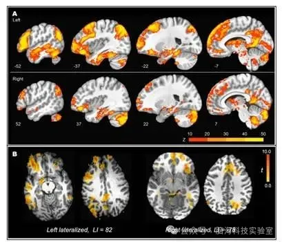 Neuroimage-Clinical：通过术前fMRI预测左侧颞叶癫痫手术后的记忆衰退：一项多中心研究