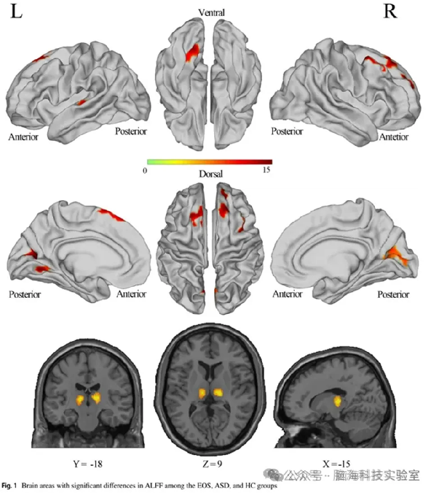 精神分裂症合集 | 以往高分文献分析，揭示精神分裂症研究热点