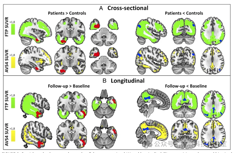 Ann Neurol: 阿尔茨海默病中海马体网络连接的纵向变化