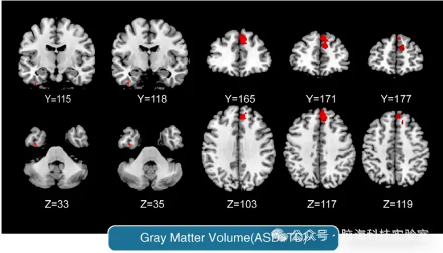 自闭症合集 | 以往高分文献分析,揭示自闭症研究热点