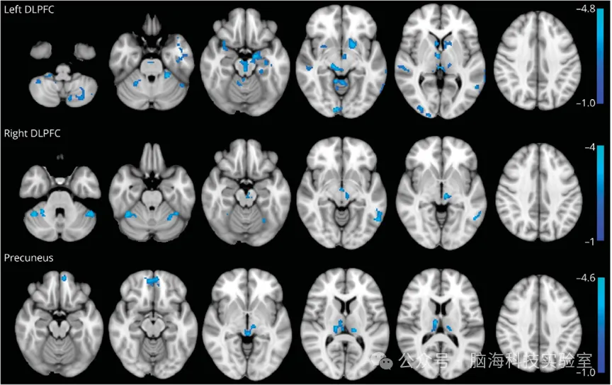 帕金森合集 | 以往高分文献分析,揭示帕金森研究热点