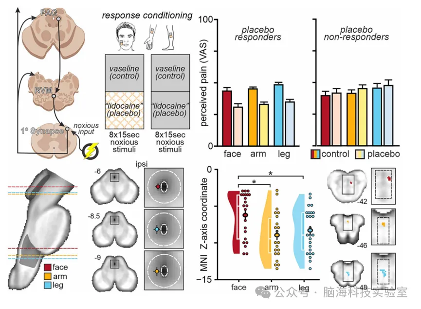 Science：新发现 ！安慰剂缓解疼痛的作用在人体中各有不同