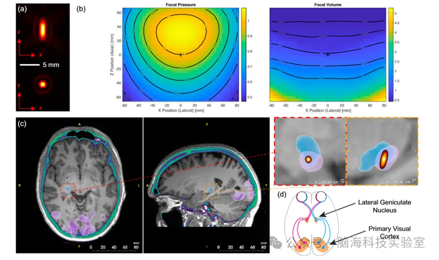 Nature Communications：新技术！超声头盔可在无需手术的情况下实现对人脑深部的刺激