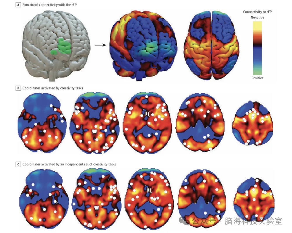 往期精彩|JAMA Network Open:MRI 映射确定创造力的大脑回路