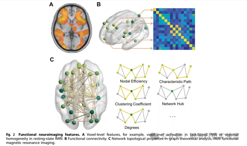 Transl Psychiat:注意缺陷/多动障碍中的机器学习:理解神经机制的新方法