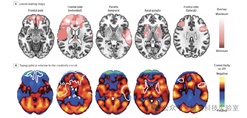 往期精彩|JAMA Network Open：MRI 映射确定创造力的大脑回路