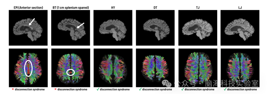 PNAS：裂脑研究发现：仅需少量神经纤维即可实现大脑两半球间的信息交流