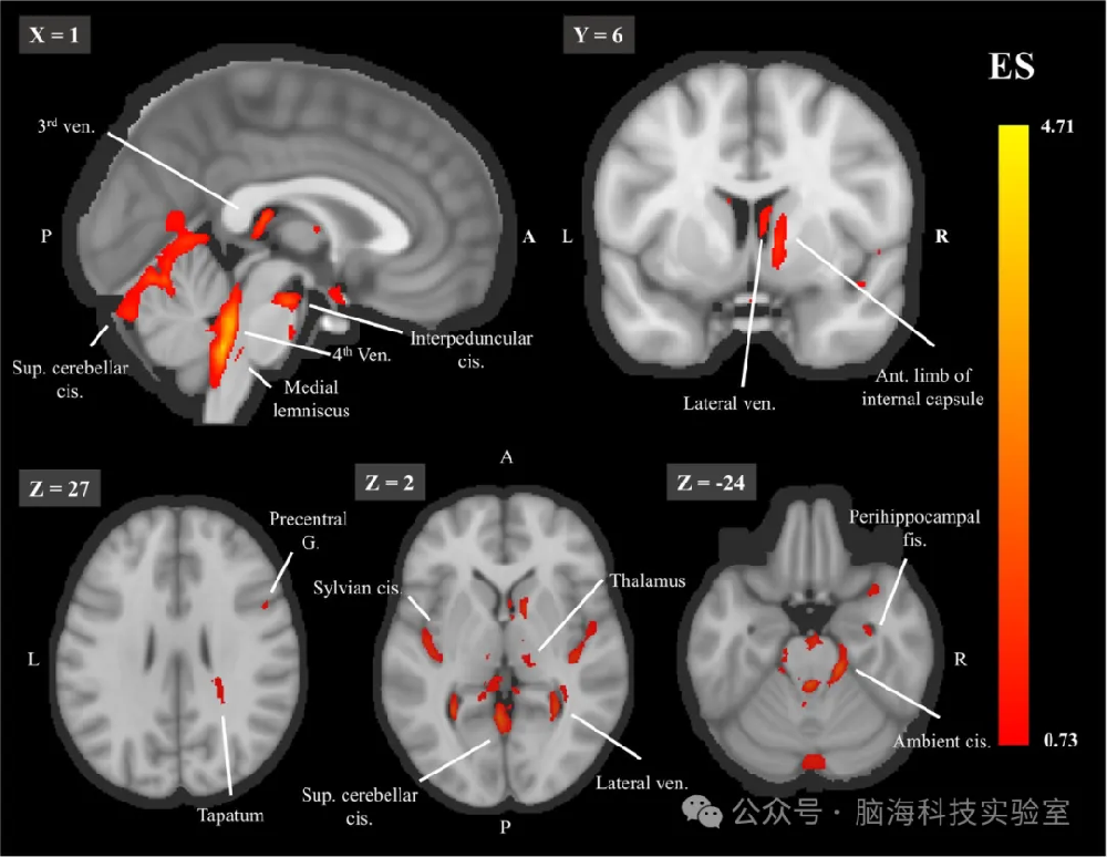 往期精彩|Hum Brain Mapp.：从深度学习模型回归大脑：揭示区域预测因子及其与衰老的关系