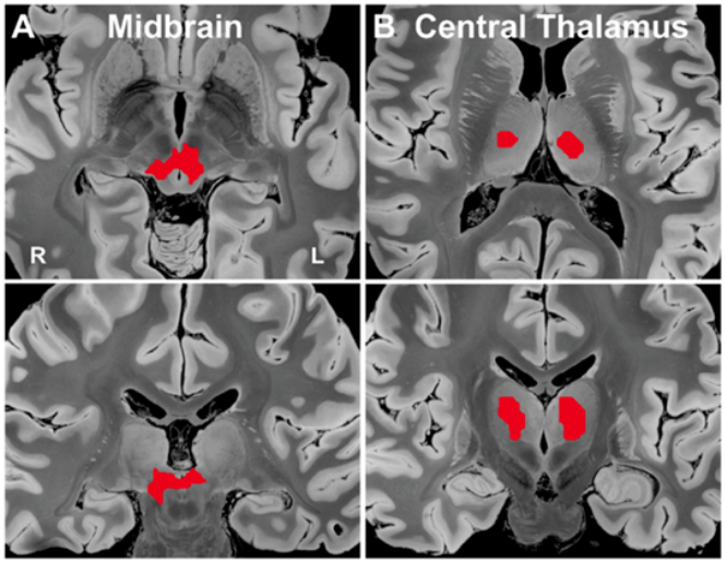 往期精彩|NeuroImage: 深部脑区是意识的关键？多感官信息在此汇聚
