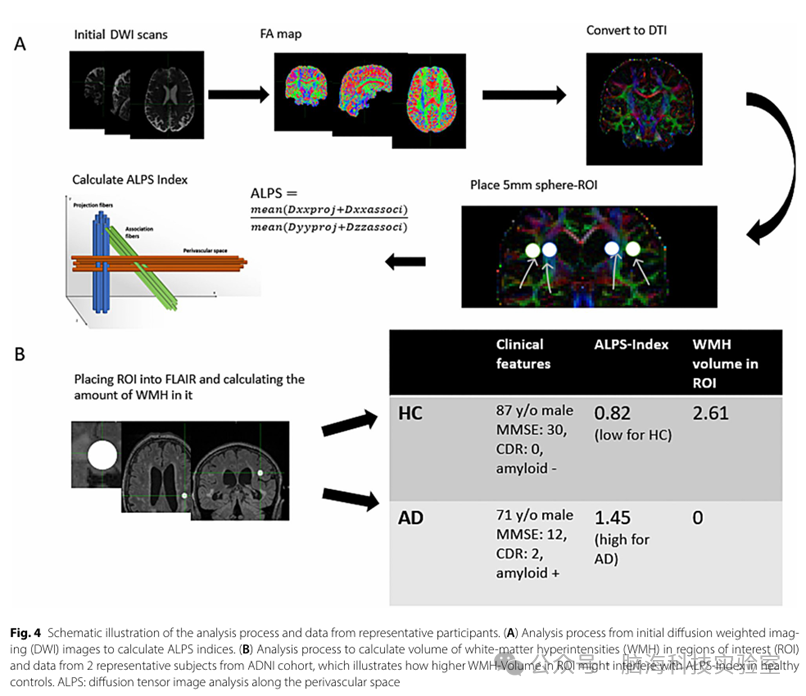 往期精彩|Alzheimers Res Ther：DTI-ALPS指数！破解阿尔茨海默病淋巴功能障碍的生物标志物！