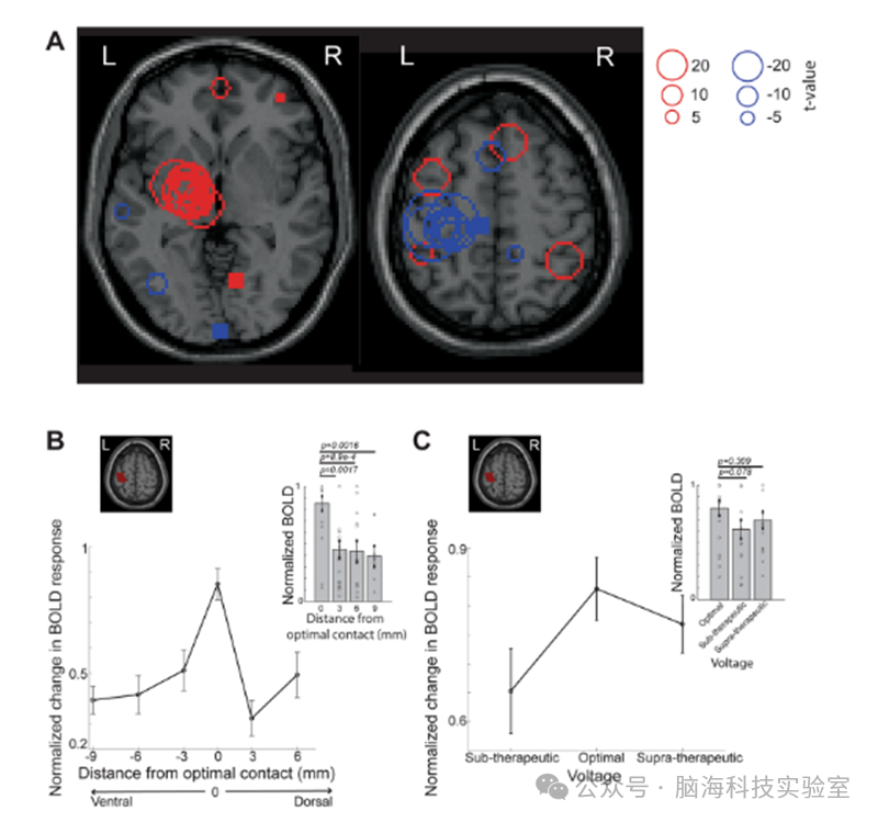 往期精彩|Nature子刊：利用功能磁共振成像和机器学习预测帕金森病的最佳脑深部电刺激参数