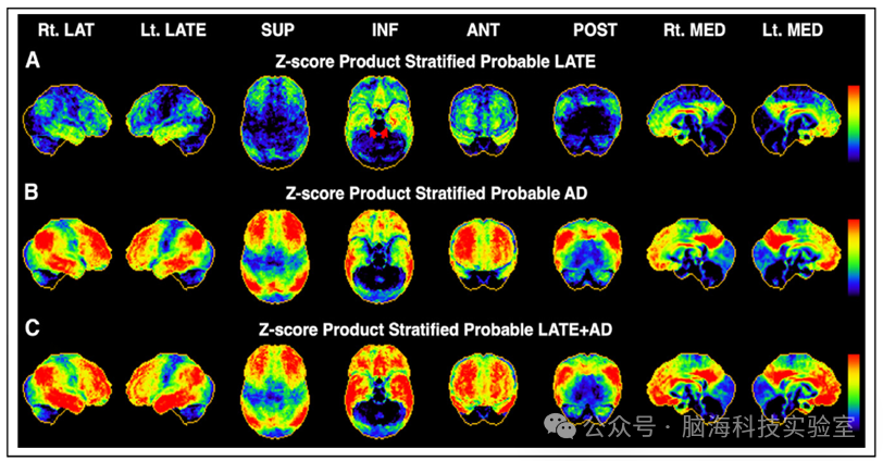 J. Nucl. Med:新研究!PET和MRI预测边缘显性年龄相关性TDP-43脑病和阿尔茨海默病