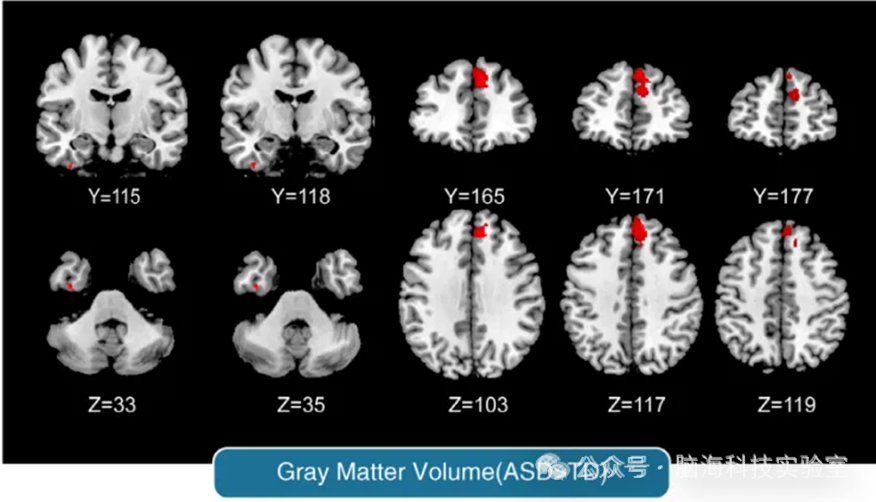 往期精彩|自闭症合集 | 以往高分文献分析，揭示自闭症研究热点