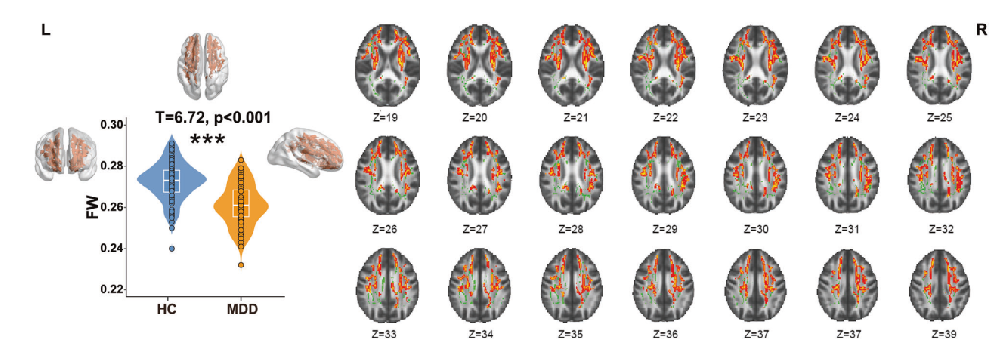 Transl Psychiat：无药物治疗青少年抑郁患者的白质自由水与抑郁症状：外周炎症的调节作用