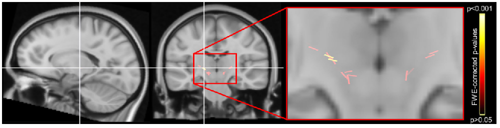 Movement Disorders：颈部肌张力障碍中头部神经整合器的异常连接